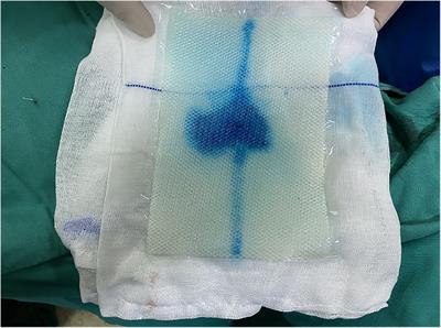 A novel auxiliary fixation technique of meshes in intraperitoneal onlay mesh procedures for incisional hernia repair